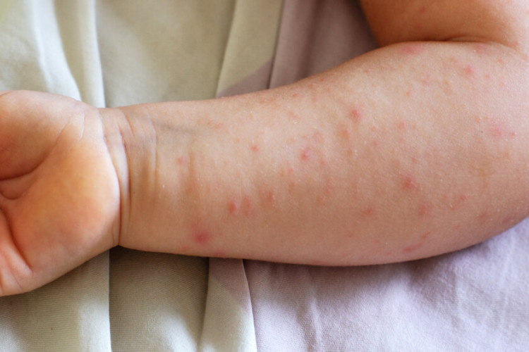 Mališani iz Bijeljine morbilama se zarazili u privatnoj ambulanti