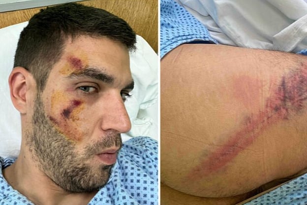 Policajci u Valjevu pretukli i bivšeg kolegu, advokat objavio fotografije