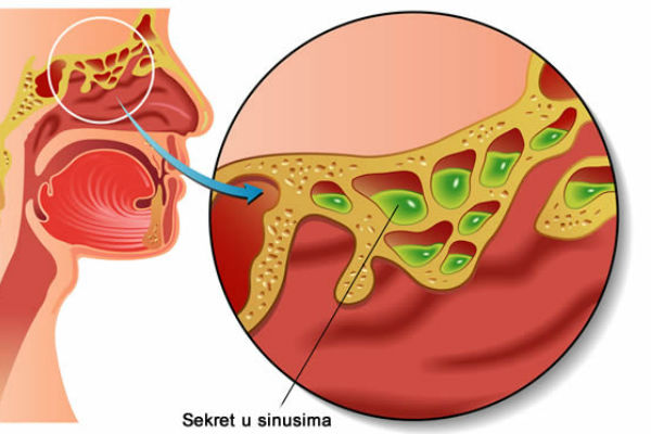 Očistite vaše sinuse i oslobodite se začepljenog nosa u nekoliko minuta