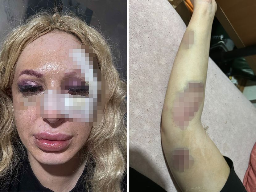Muž četiri puta gubio svijest, ženi smrskali lice: Krvničko prebijanje bračnog para u beogradskoj kafani