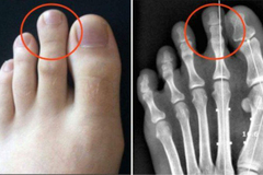 EVO ZAŠTO SAMO 14% STANOVNIŠTVA IMA DUŽI DRUGI PRST: Gledaćete ih drugim očima!