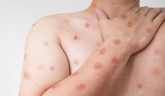  NOVI VIRUS PRIJETI U FBiH dva NOVA pacijenta sa slikom majmunskih boginja