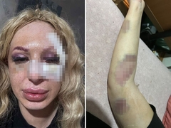 Muž četiri puta gubio svijest, ženi smrskali lice: Krvničko prebijanje bračnog para u beogradskoj kafani