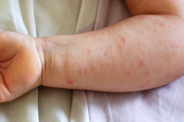 Mališani iz Bijeljine morbilama se zarazili u privatnoj ambulanti