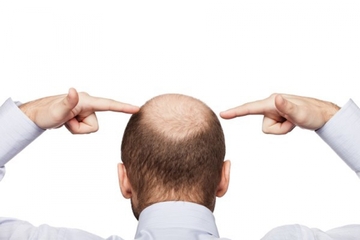 Jesu li ćelavi muškarci muževniji i kakve veze s gubitkom kose ima genetika?