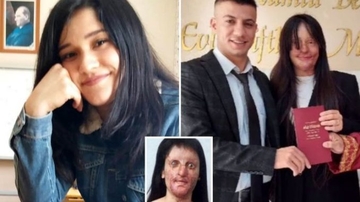 Žena opečena kiselinom (20) udaje se za onog koji joj je kiselinom unakazio lice /foto/